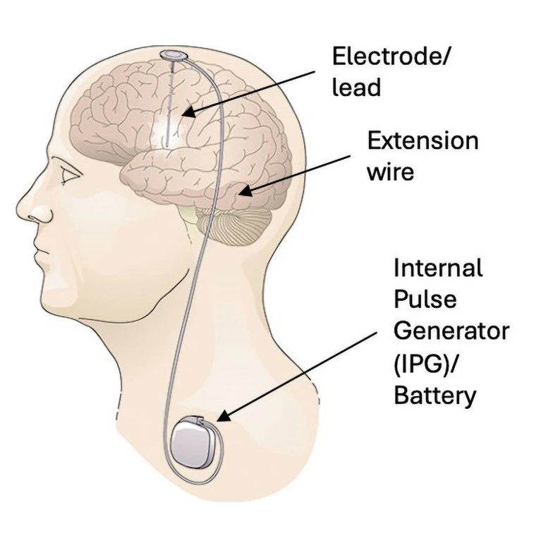 Diagram of a DBS system: lead in the brain, extension wire in the neck, battery in the chest