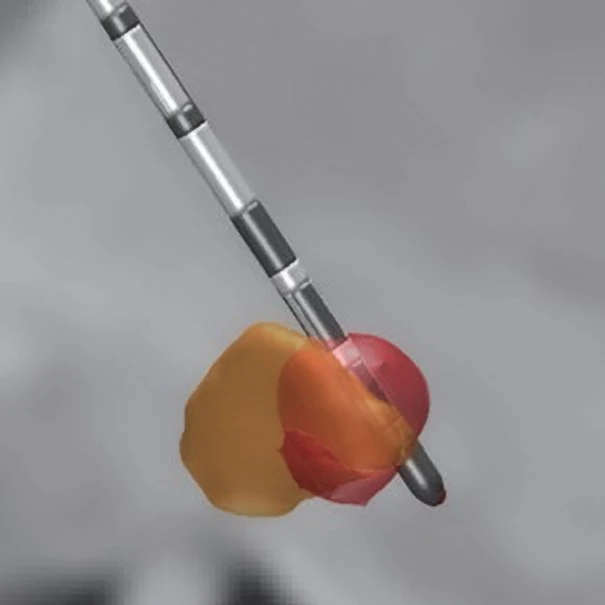 A segmented directional DBS lead steering stimulation toward one side of the target