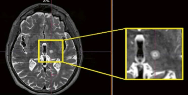An MRI image showing a completed lesion in the VIM nucleus