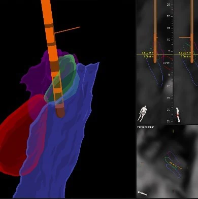 An intraoperative image confirming lead location before closing