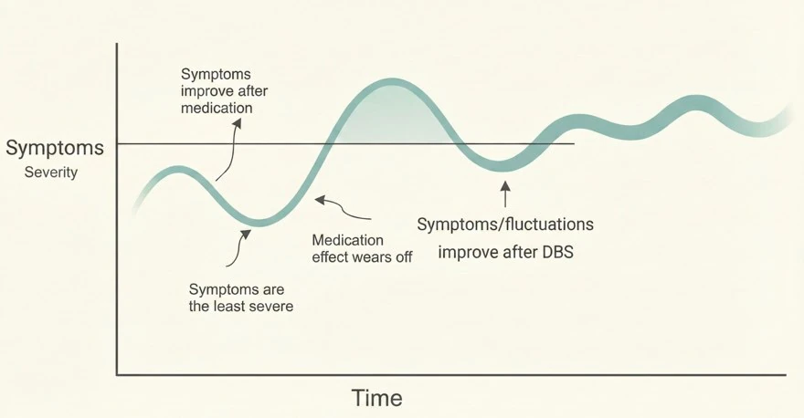 A day before and after DBS: the swings between ON and OFF flatten out